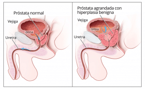 próstata